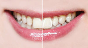 Durchsichtig und flexibel sitzt die Harmonieschiene auf Ihren Zähnen sanft wie eine Kontaktlinse. Foto: Orthos Fachlabor für Kieferorthopädie GmbH & Co. KG